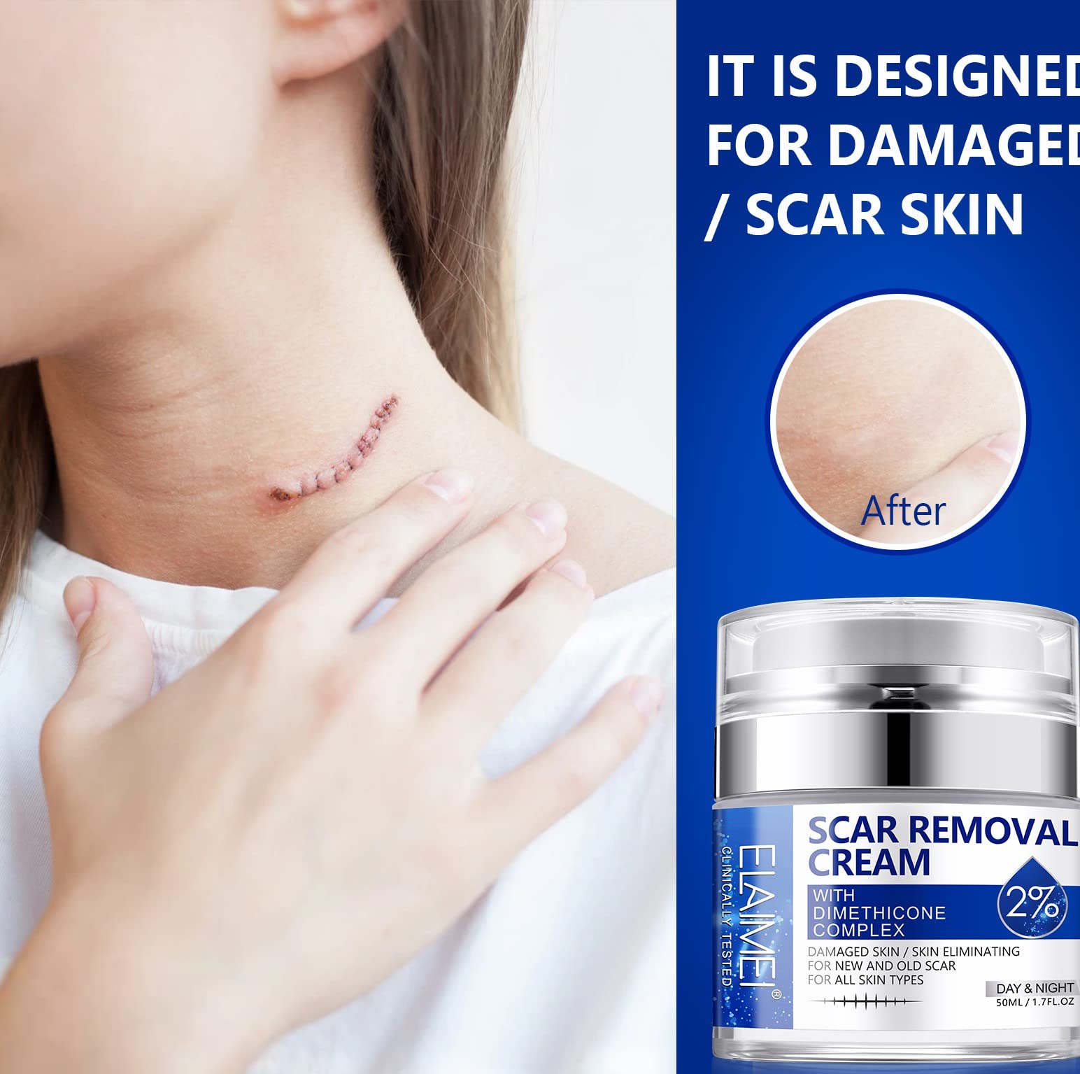SBHEANGBA Scar Cream on acne scars for smoother, even skin
