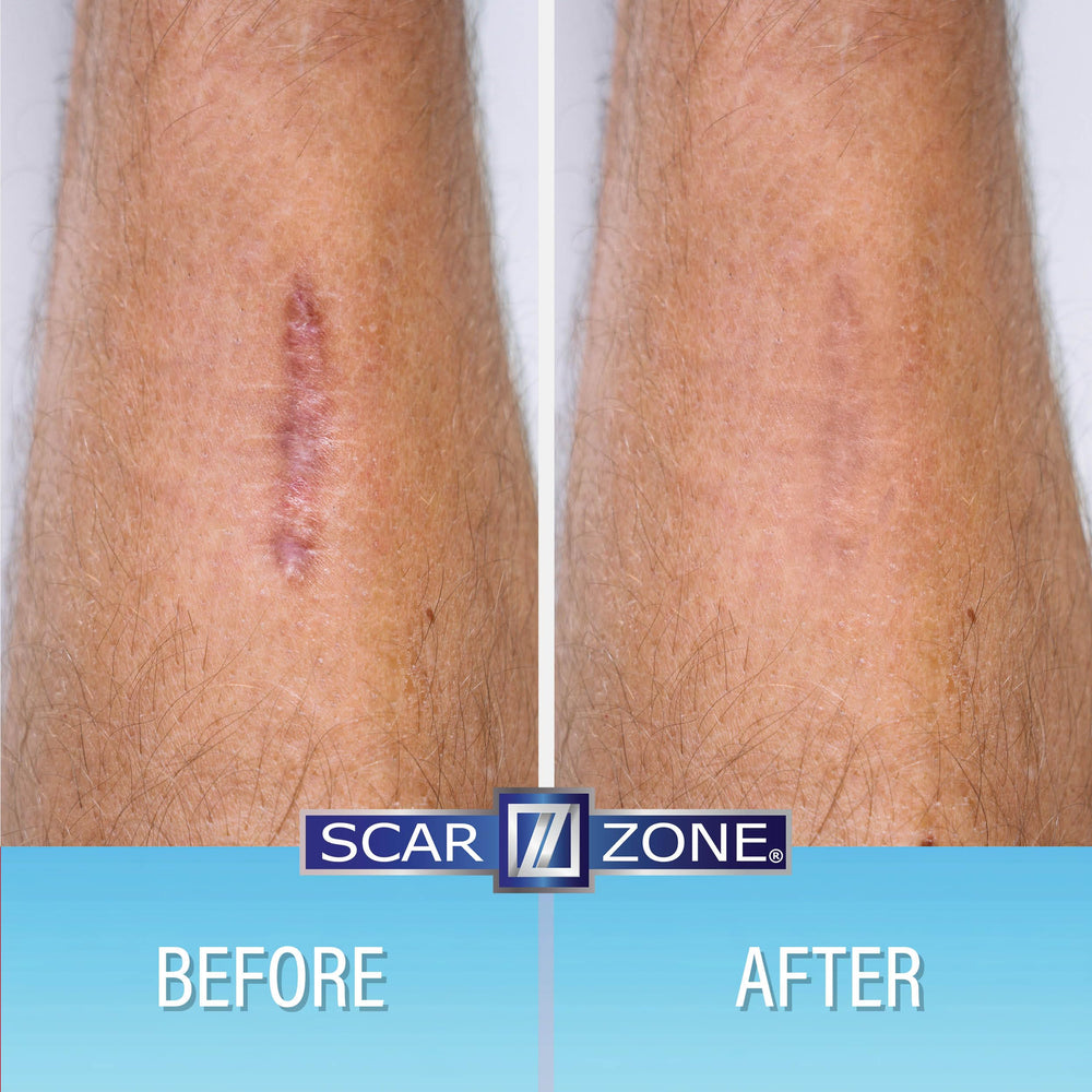 SCAR ZONE Advanced Scar Cream application demonstrating easy daily use.