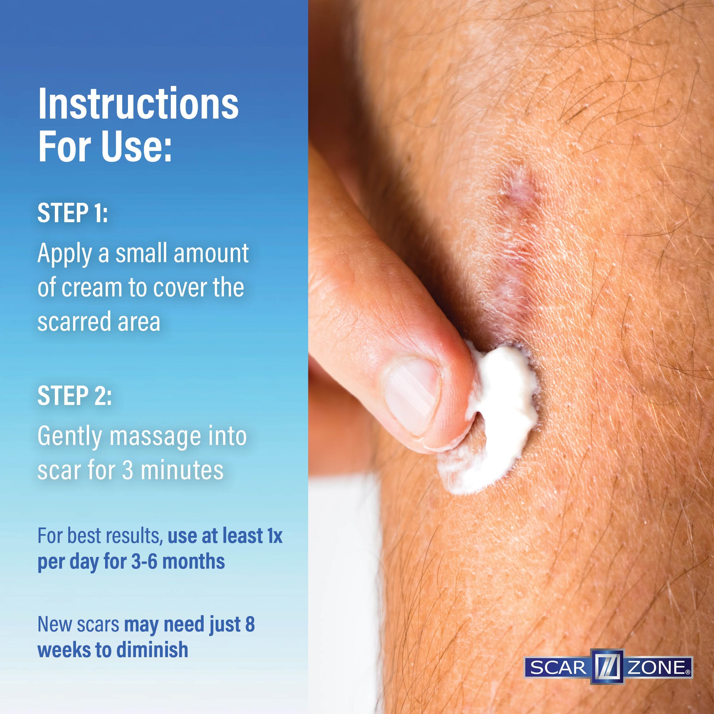 SCAR ZONE Advanced Scar Cream before and after comparison visuals.