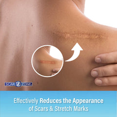 SCAR ZONE Advanced Scar Cream with dimethicone for lasting moisture on skin.