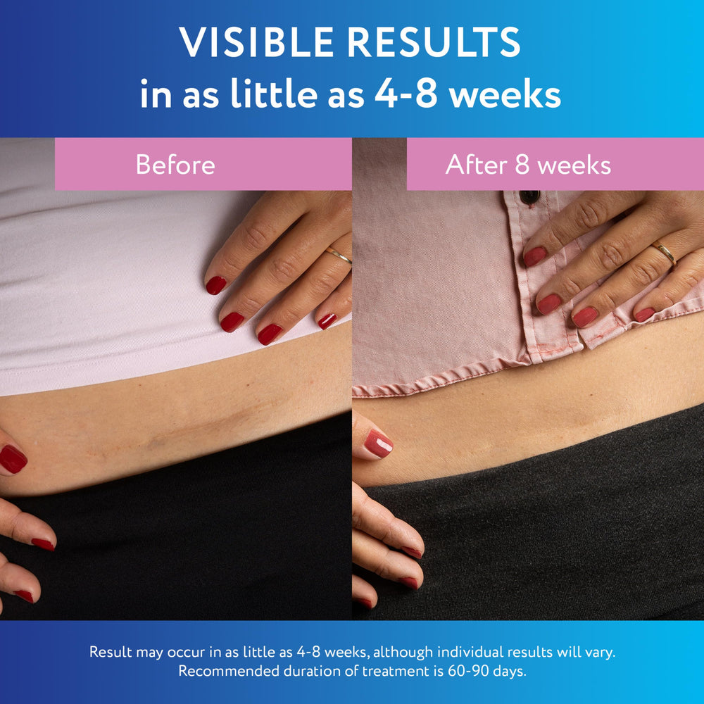 ScarAway medical-grade silicone technology trusted by clinicians.