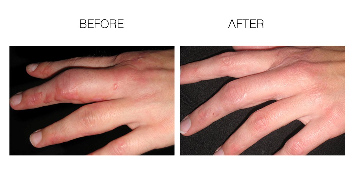 Close-up of skin with ScarFade gel softening a scar texture