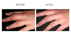 Close-up of skin with ScarFade gel softening a scar texture