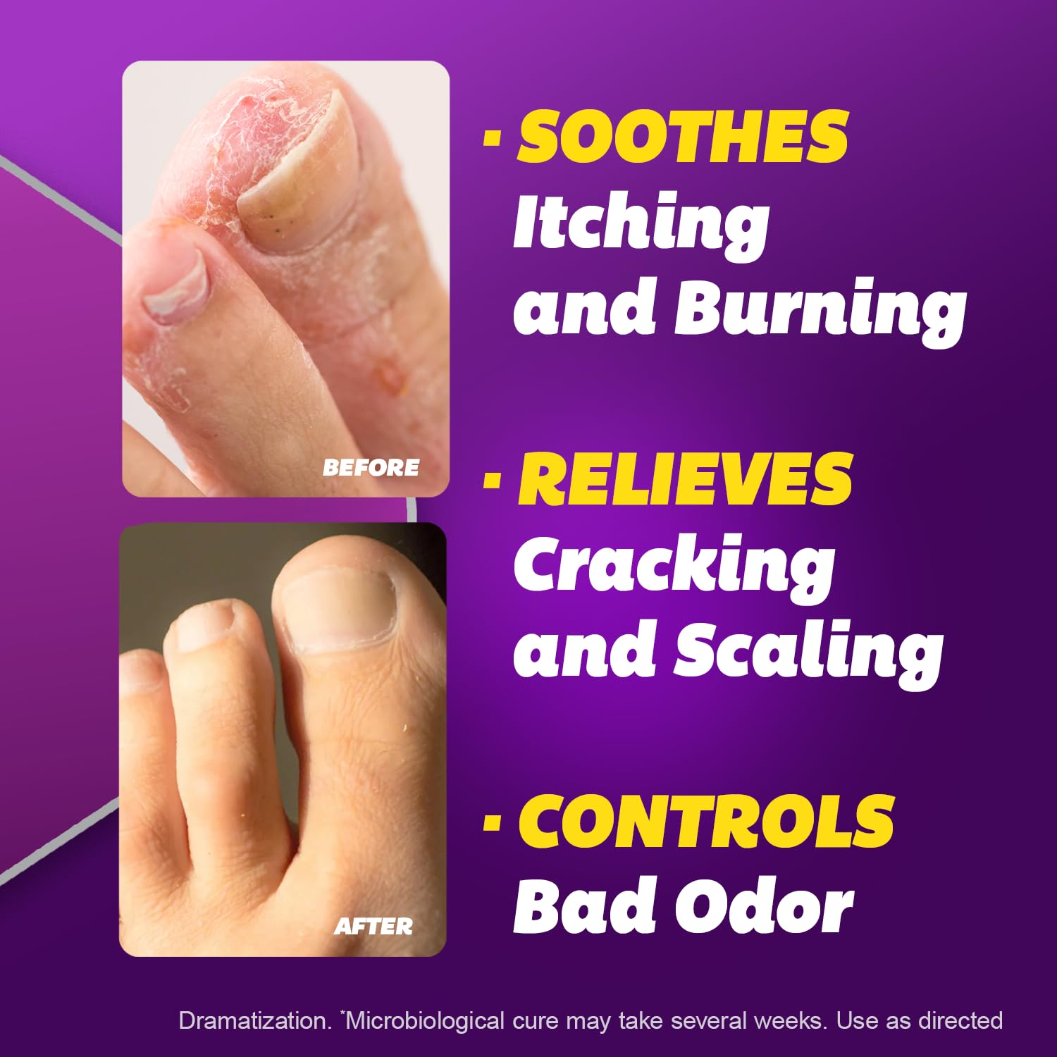 Silka application between toes demonstrating targeted relief twice daily