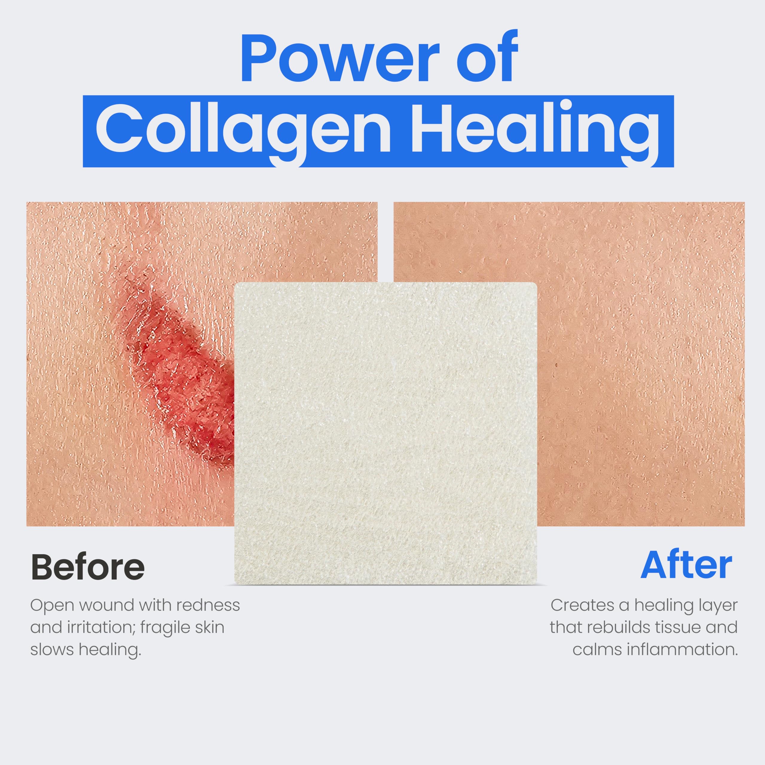 Simpurity collagen dressing 5-pack supports convenient at-home wound care.