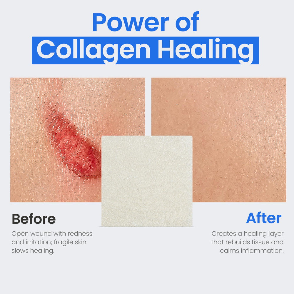 Simpurity collagen dressing pad wound-application demo shows ease.