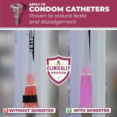 Skinister adhesive dropper securing an ostomy bag with skin protection.
