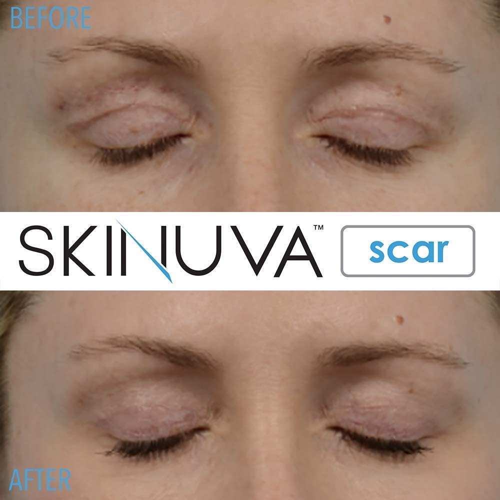 Skinuva developed by physicians for advanced scar care.