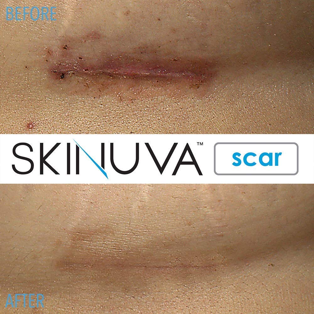 Before and after Skinuva scar treatment results.