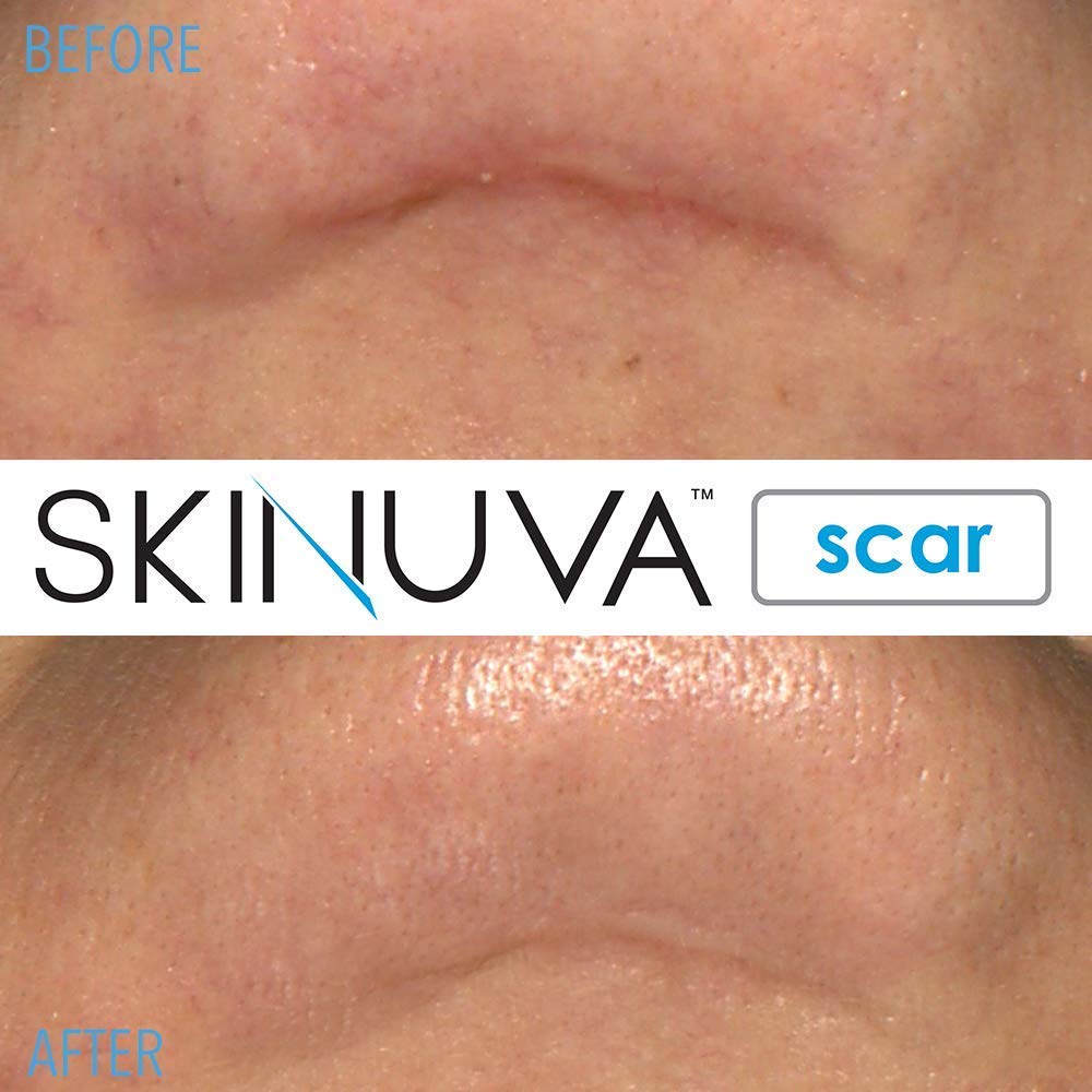 Silicone-based Skinuva layer applied to scar area.