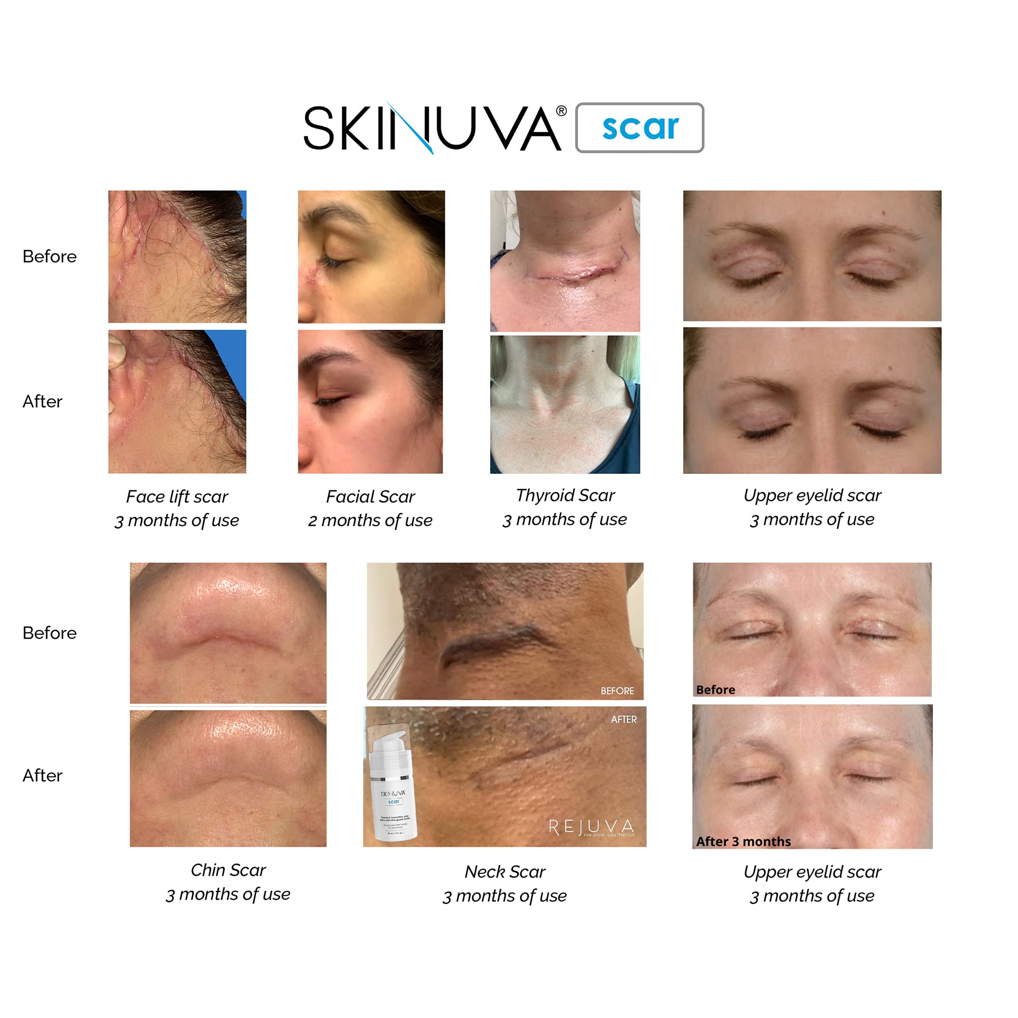 Skinuva silicone cream layer protects scar from irritation