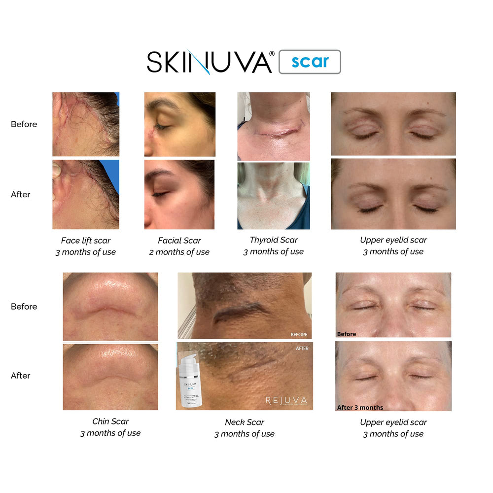 Skinuva silicone cream layer protects scar from irritation