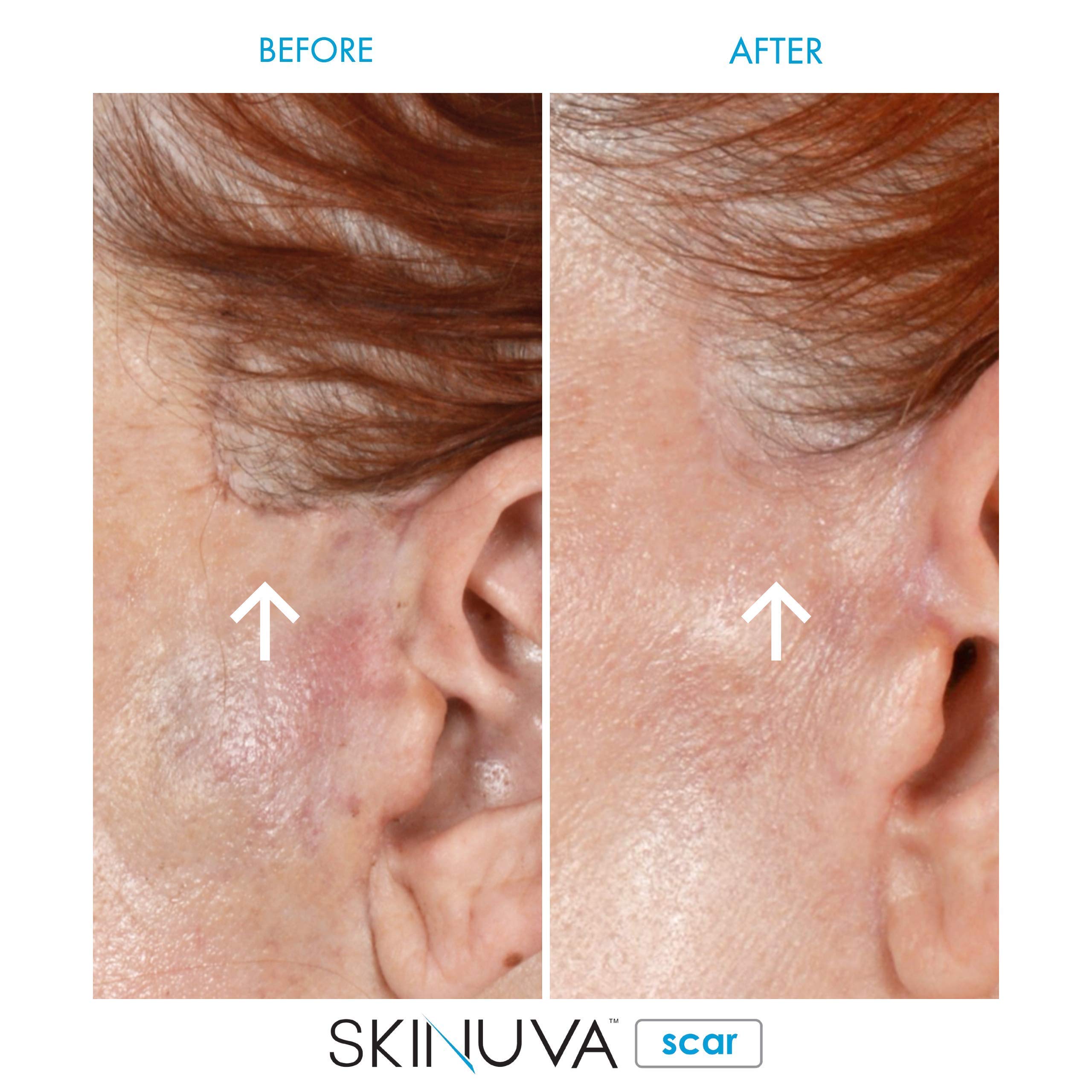 Surgical scar area treated with Skinuva for smoother appearance.