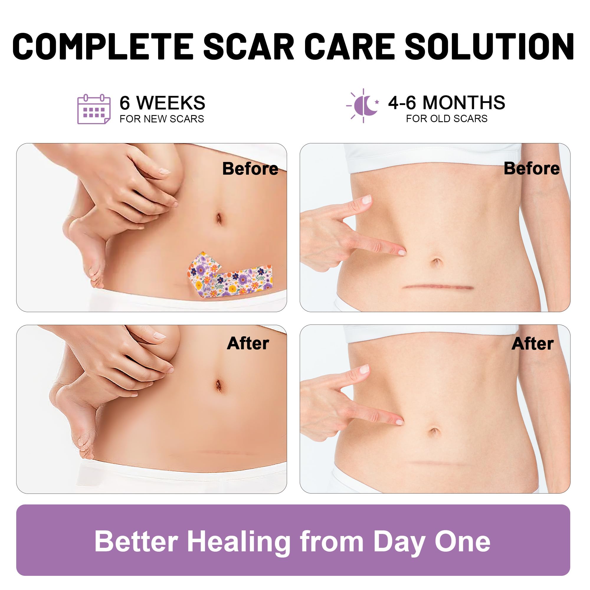 SLGCBL silicone scar sheet applied to facial area for discreet wear