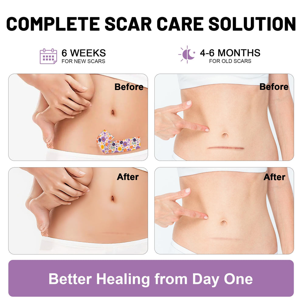 SLGCBL silicone scar sheet applied to facial area for discreet wear