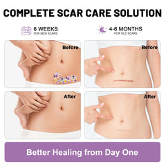 SLGCBL silicone scar sheet applied to facial area for discreet wear