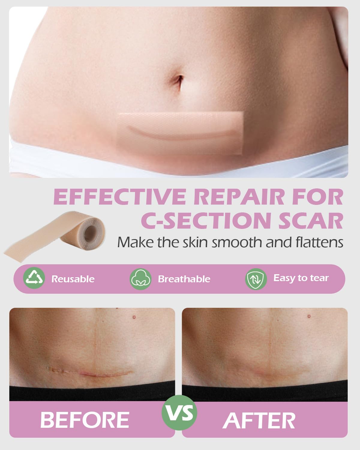 SOFTCA witch hazel pads offer cooling relief for postpartum care.