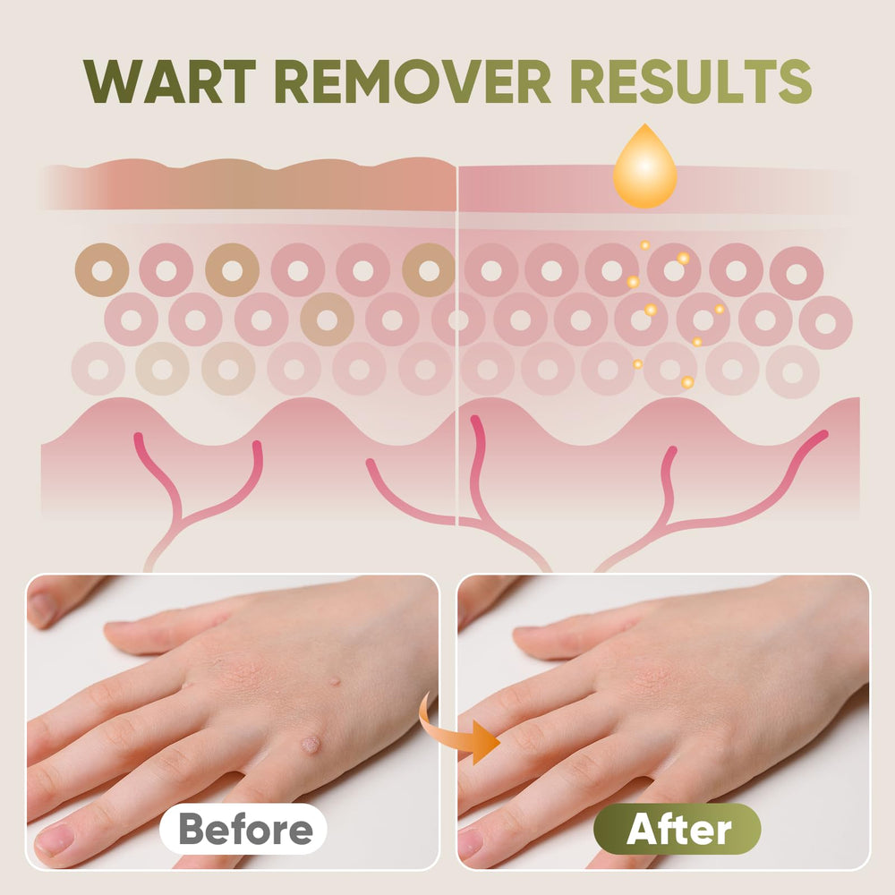STAY STOKED Wart Remover application step image showing drop-by-drop application.