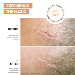 Strataderm Scar Gel applied to an old scar for smoother appearance