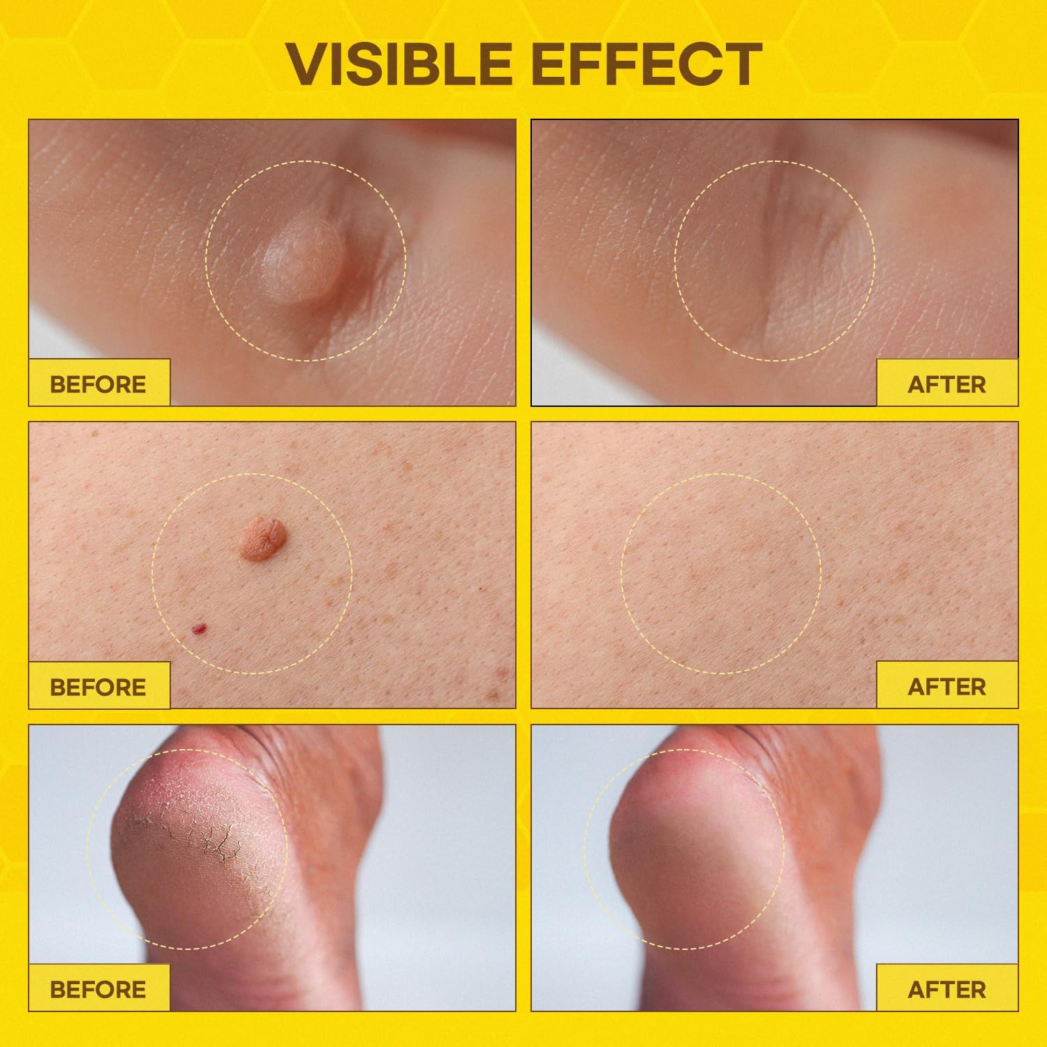 SupreH bee venom cream jar highlighting soothing, comfortable wart care.