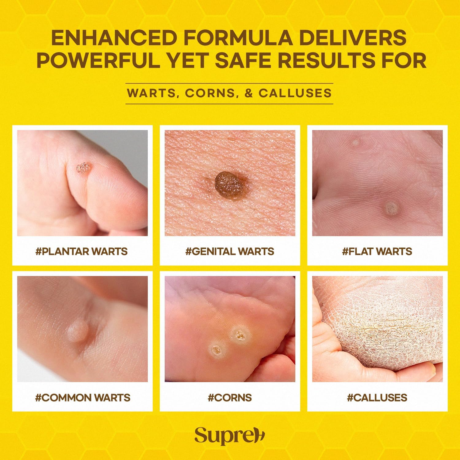SupreH genital wart treatment cream shown as discreet, gentle option.
