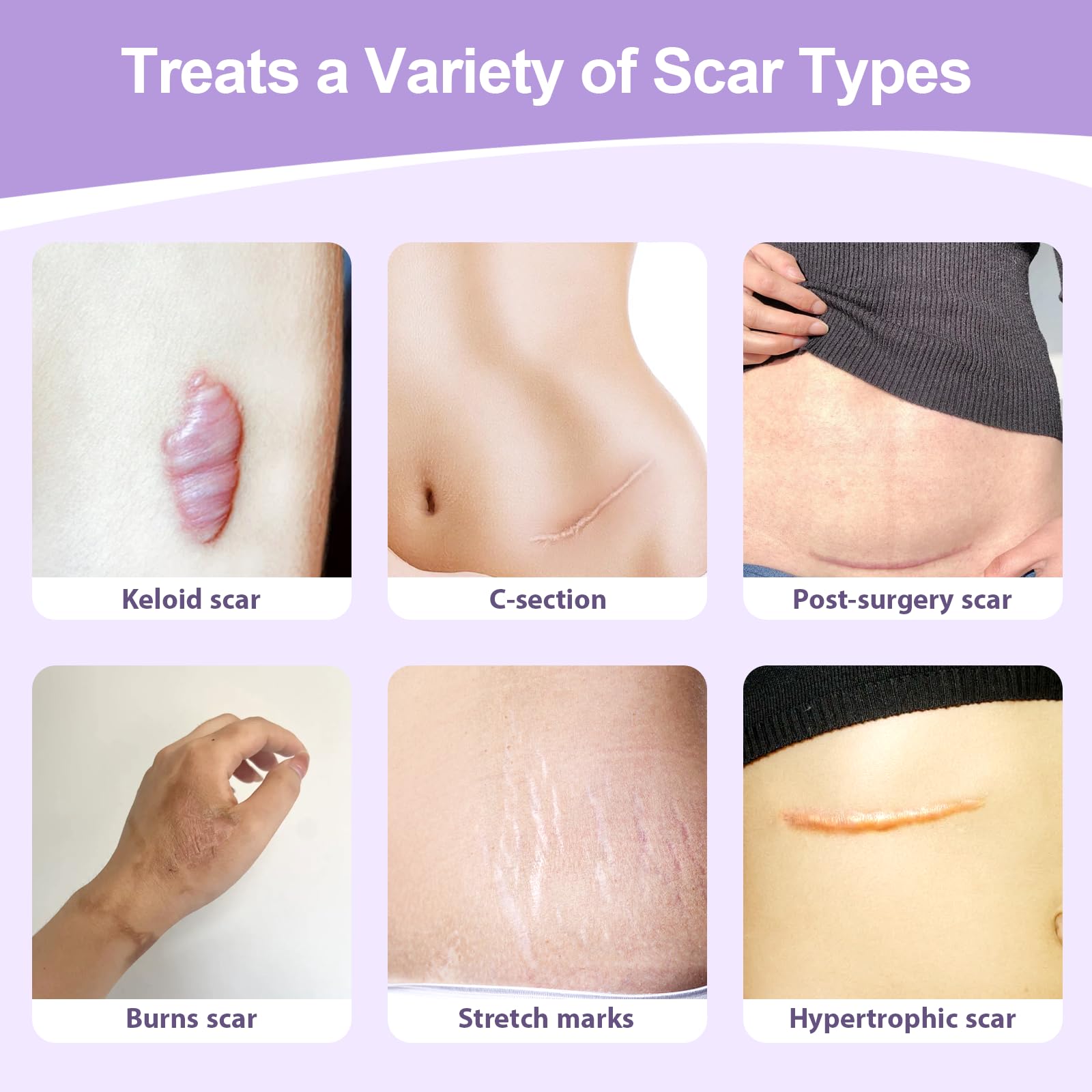 Tamuto silicone scar tape on skin shows soft-breathable wear.