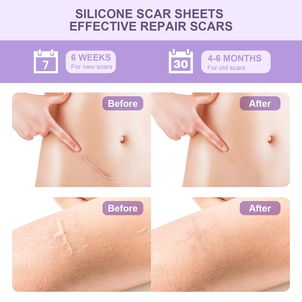 Tamuto silicone scar tape trimmed to fit a scar's shape.