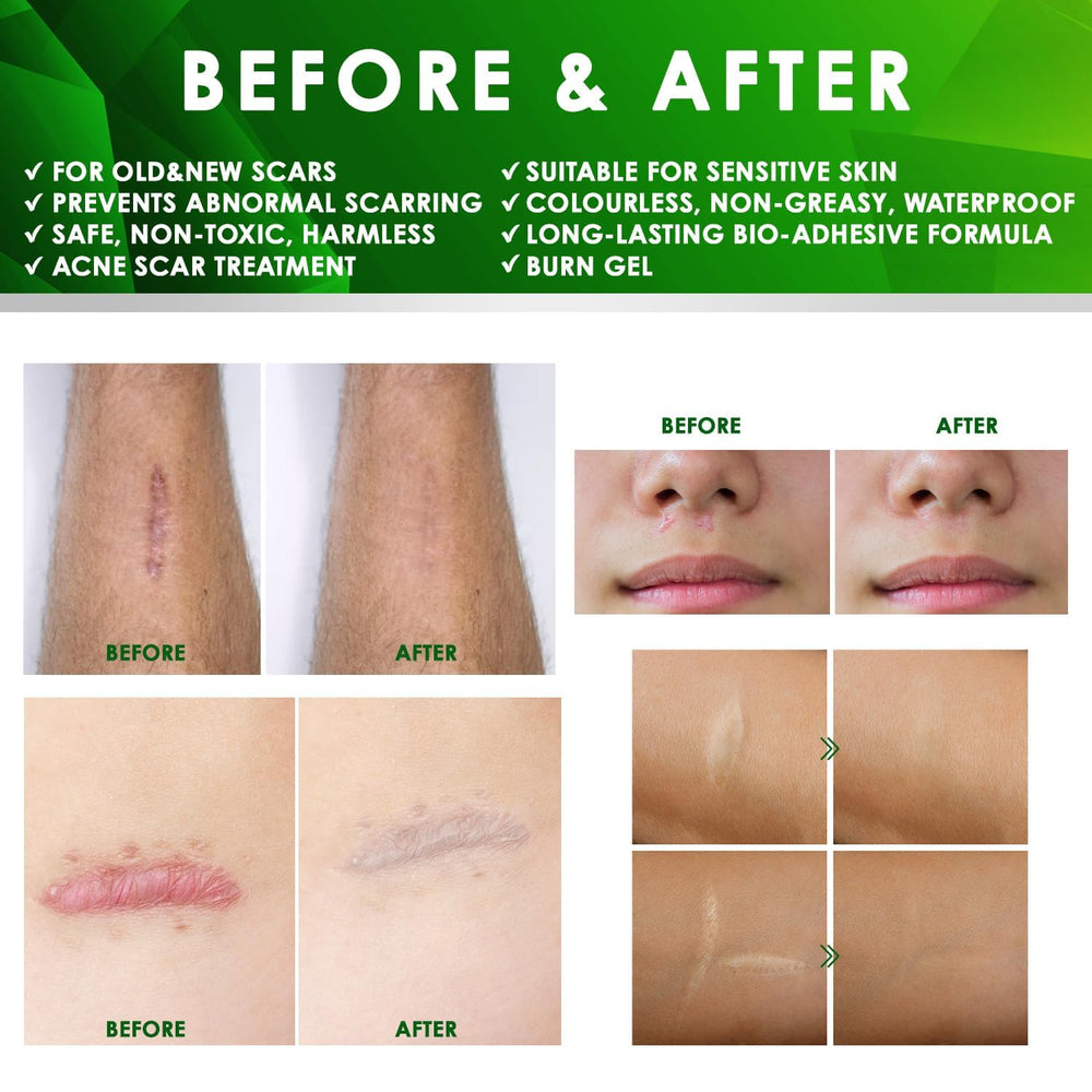 Tobcharm piercing-keloid care kit shows practical post-piercing solution.