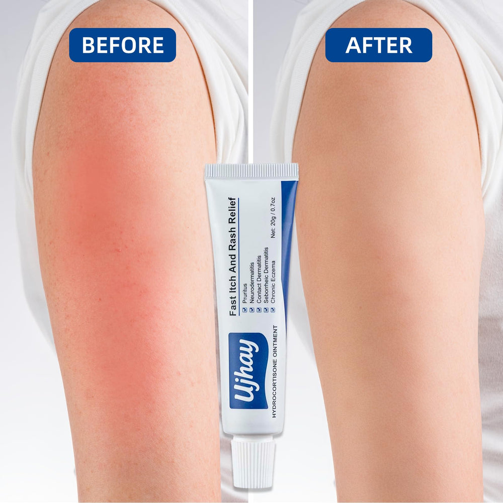 UJhay Hydrocortisone Ointment after-application showing calm skin