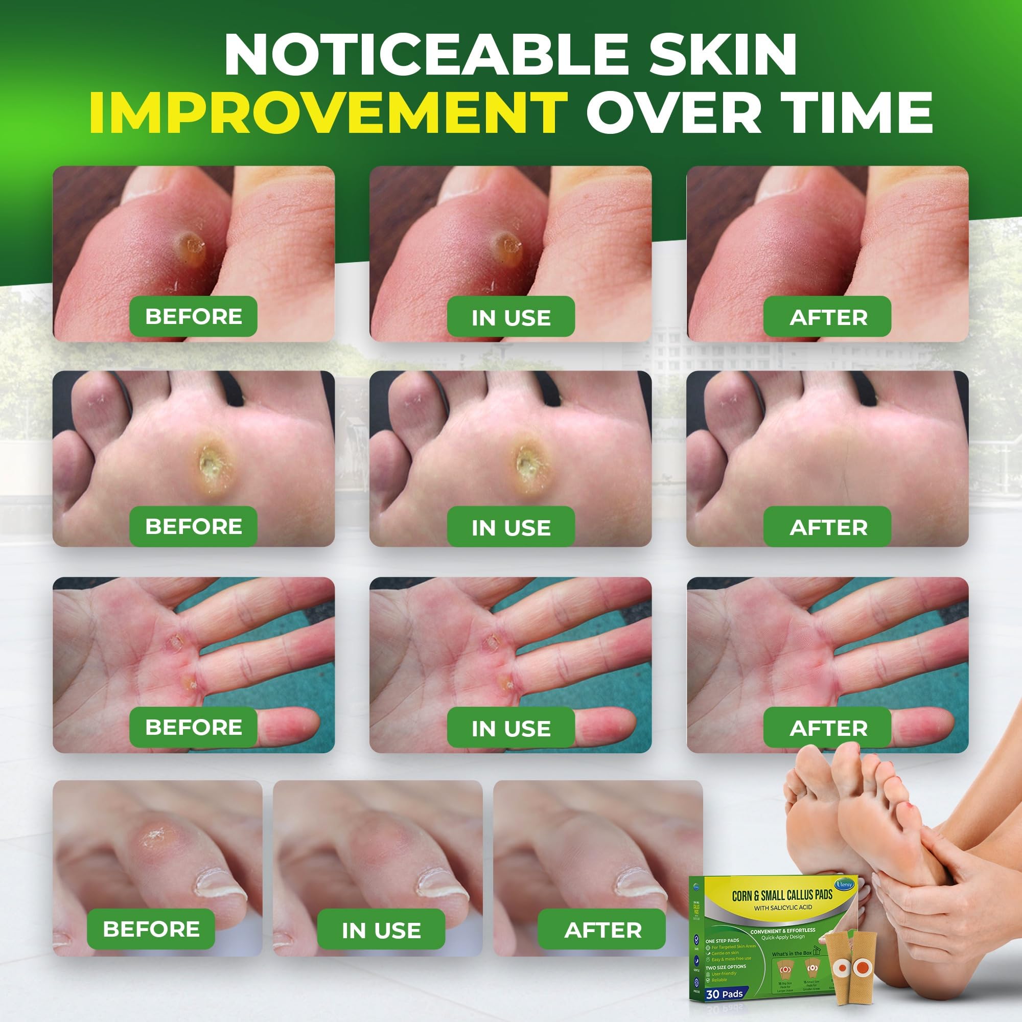 Ulensy Corn Remover Pads between toes demonstrating flexible fit.