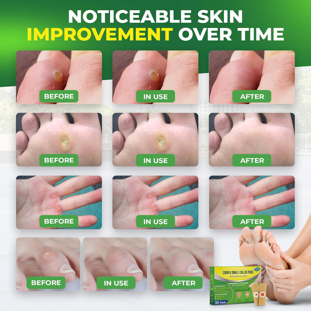 Ulensy Corn Remover Pads between toes demonstrating flexible fit.
