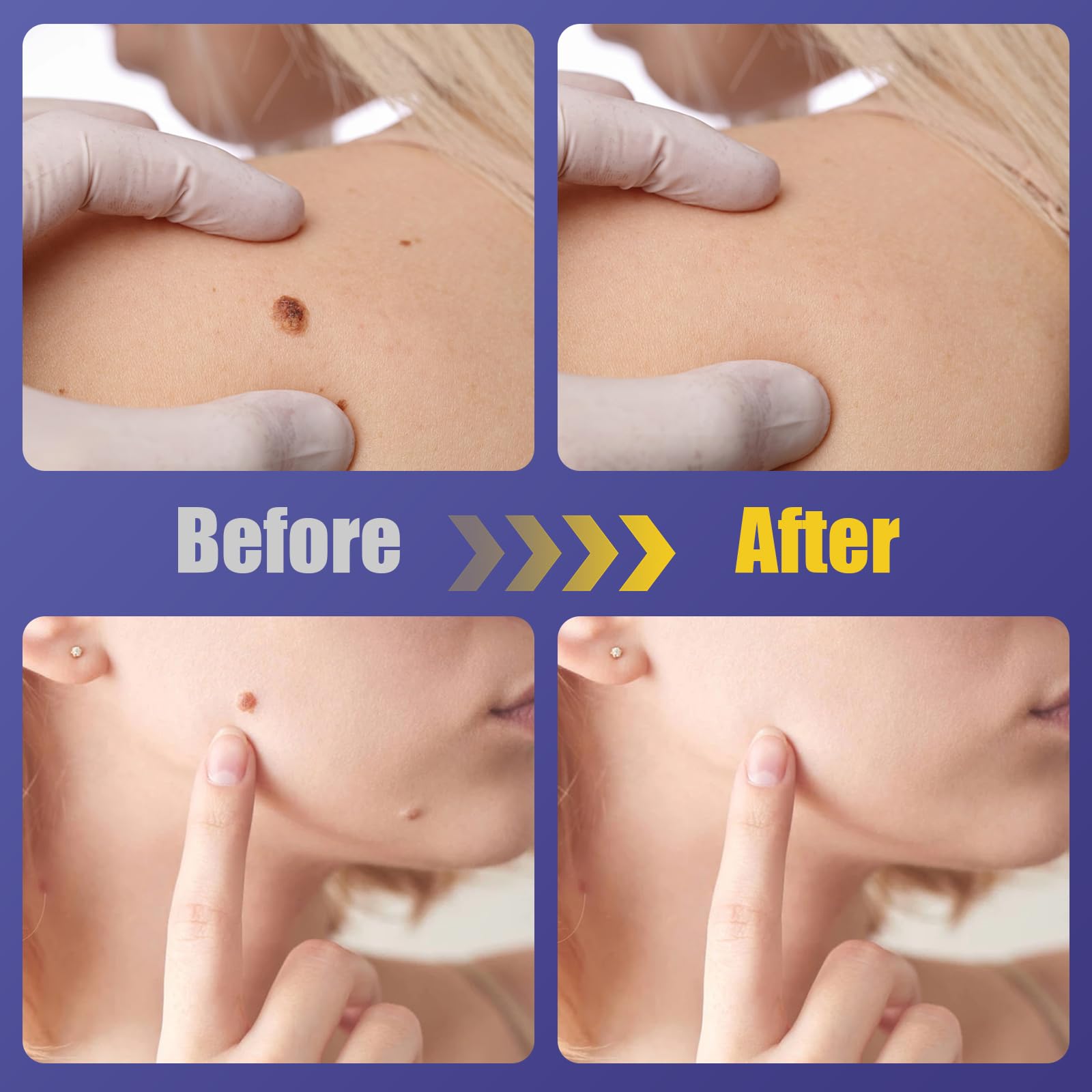 WABRINY skin-tone blend patch blends with diverse complexions