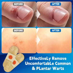 WABRINY Wart Remover Pad soft adhesive bandage shown on skin for comfort.
