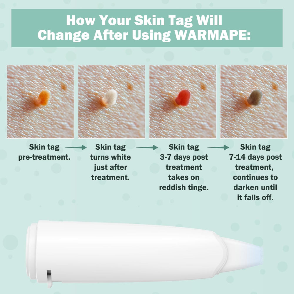 WARMAPE Skin Tag Remover in use shows precise application for safe home treatment