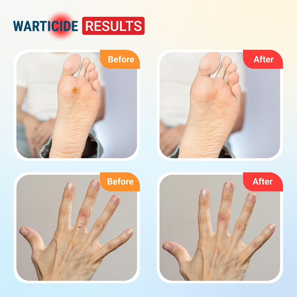 Warticide dropper application demonstrates precise self-application.