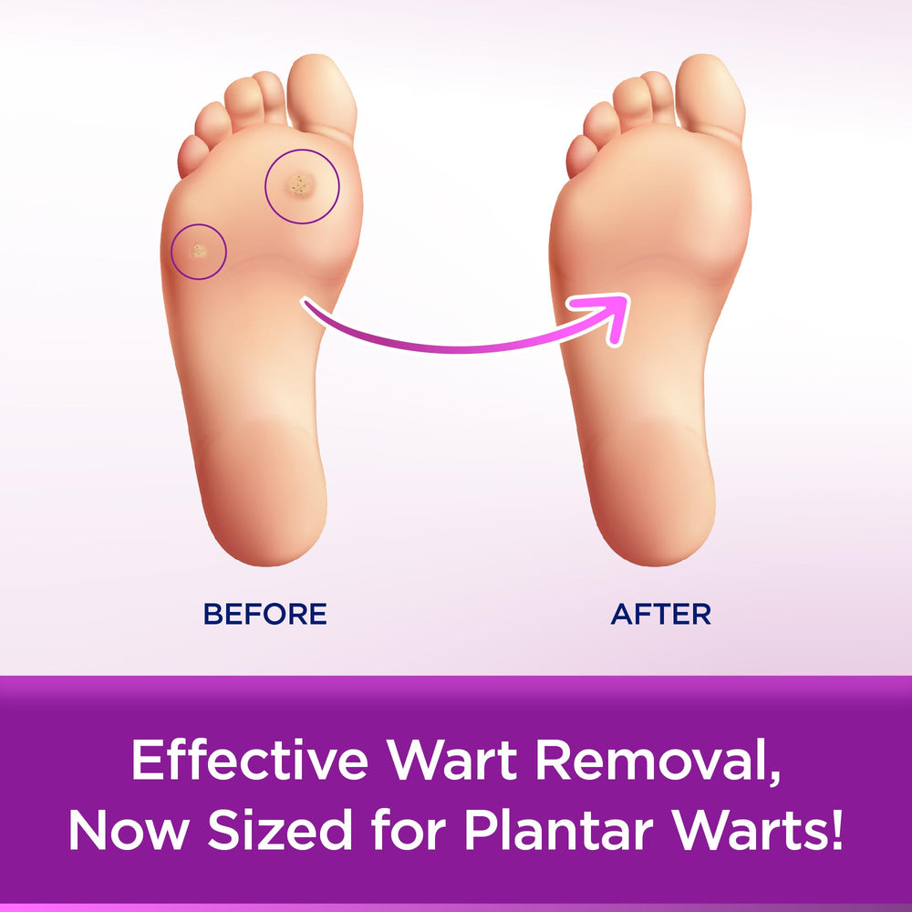 Close-up of WartStick Plantar wax formula adherent to skin.