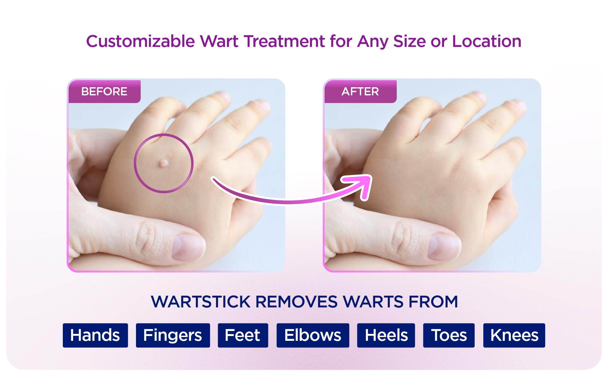 WartStick wart remover application close-up illustrating precise stick-on treatment
