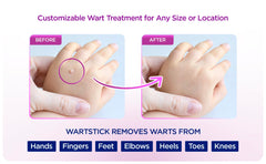 WartStick wart remover application close-up illustrating precise stick-on treatment