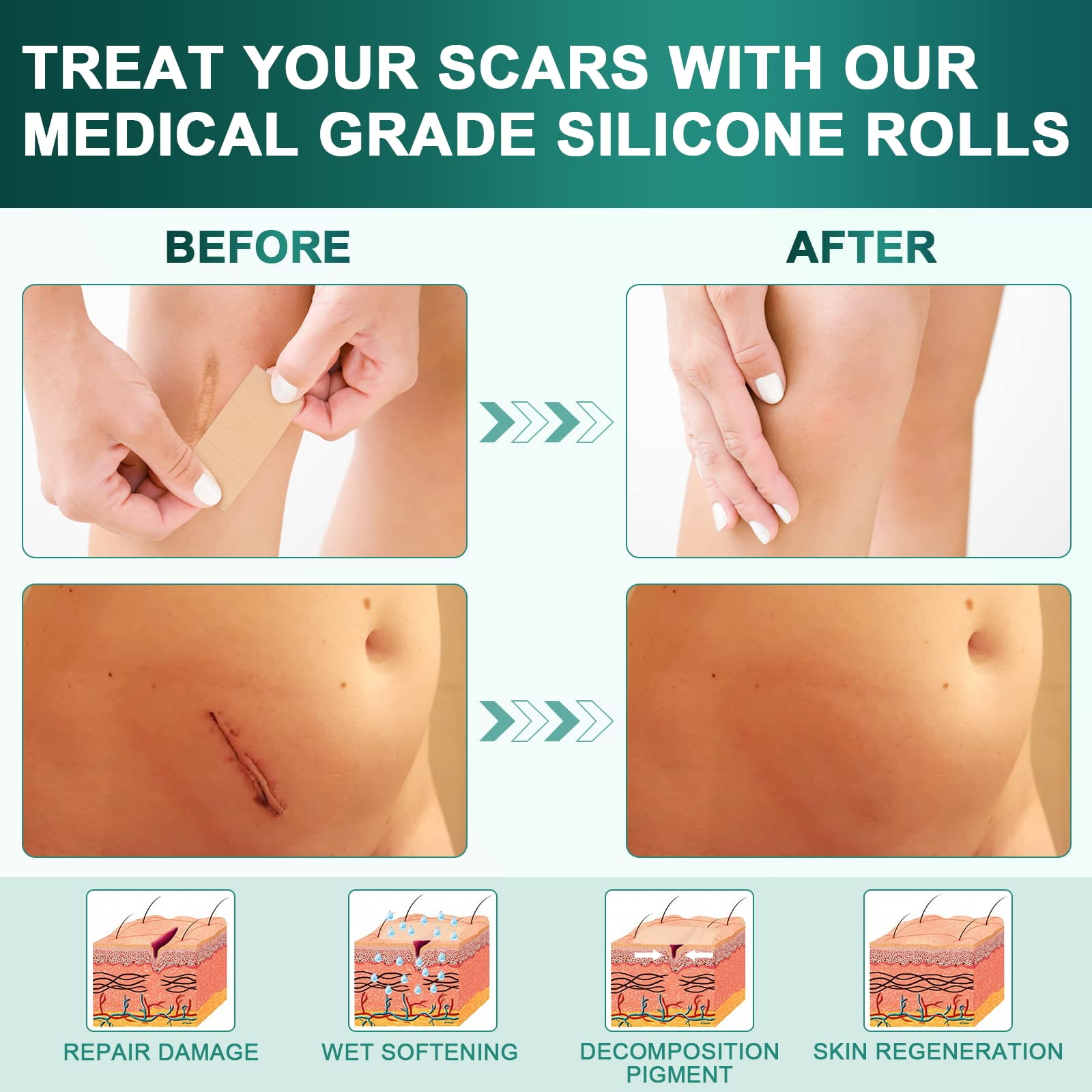 WeaShaemgLi silicone scar sheet close-up showing skin-tone shade for discreet wear