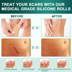 WeaShaemgLi silicone scar sheet close-up showing skin-tone shade for discreet wear