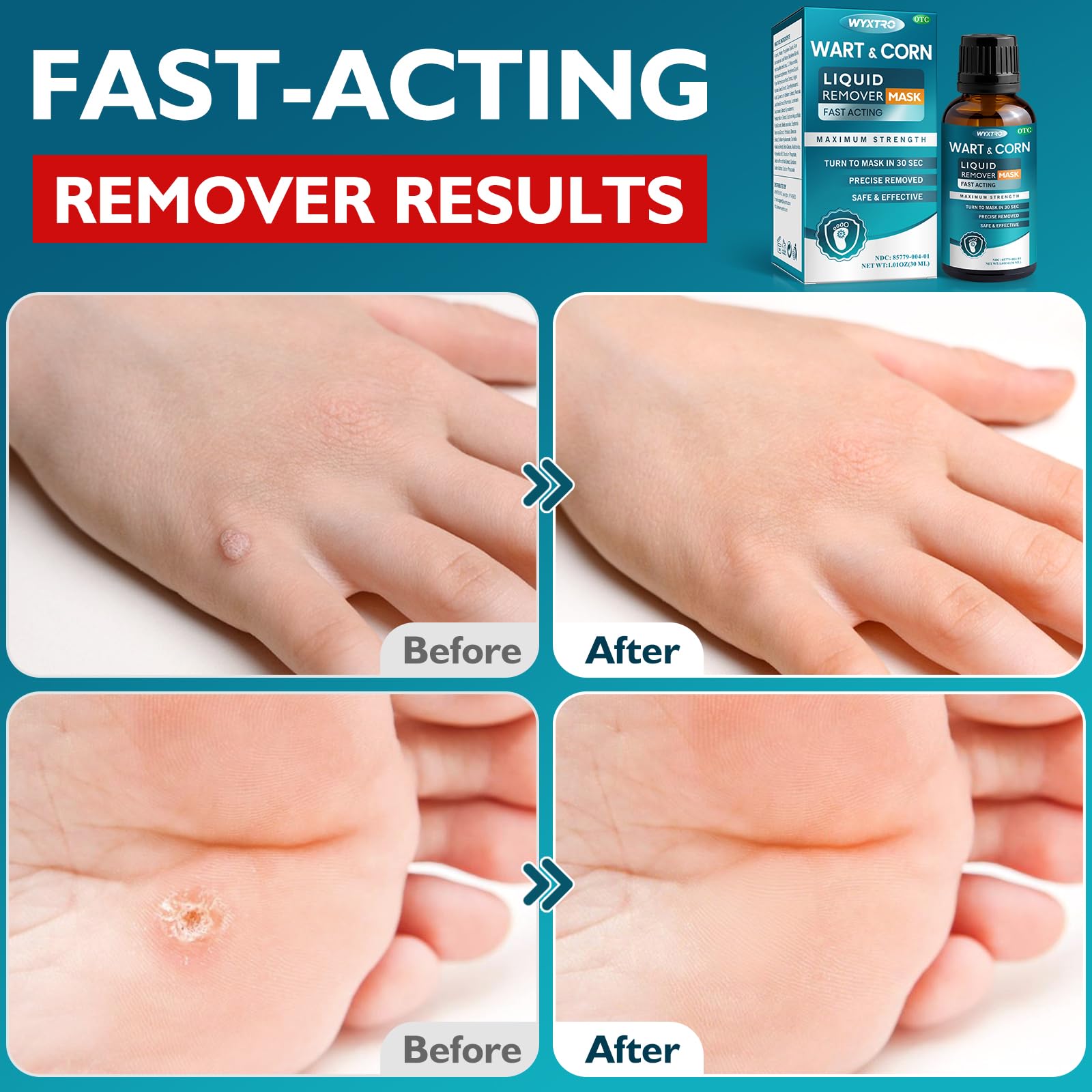 WYXTRO removes corns and calluses while softening skin for comfort.