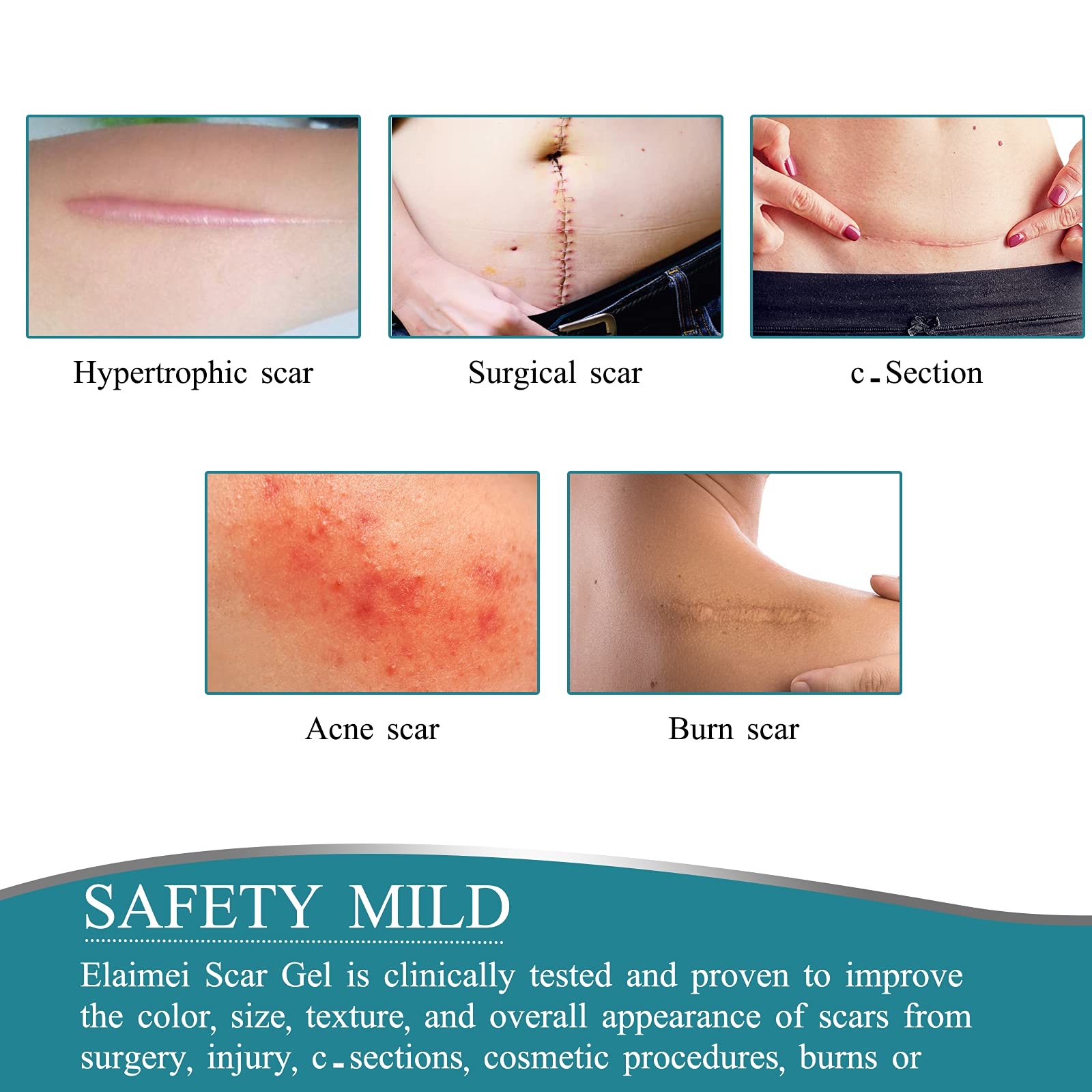 ZODENIS scar tape demonstrates pain-free removal with no residue.