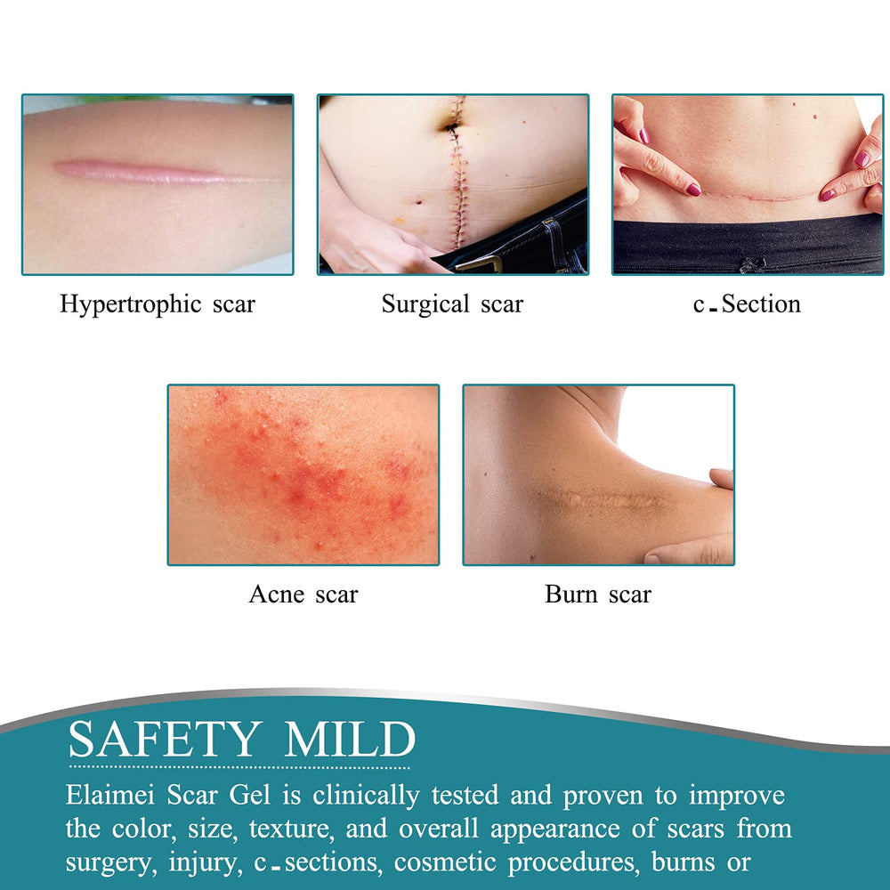 ZODENIS scar tape demonstrates pain-free removal with no residue.