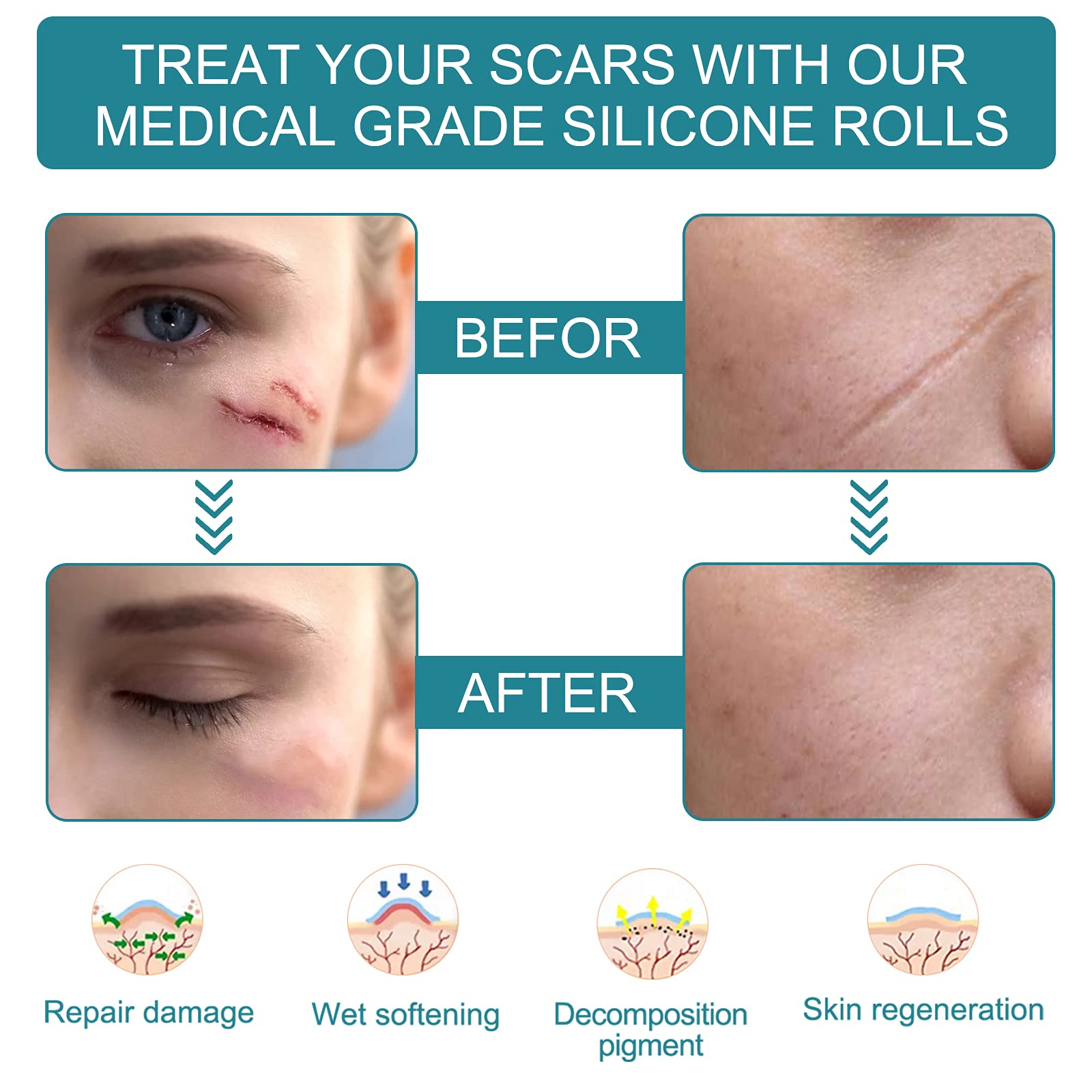 Scar tape applied over old and new scars for even coverage.
