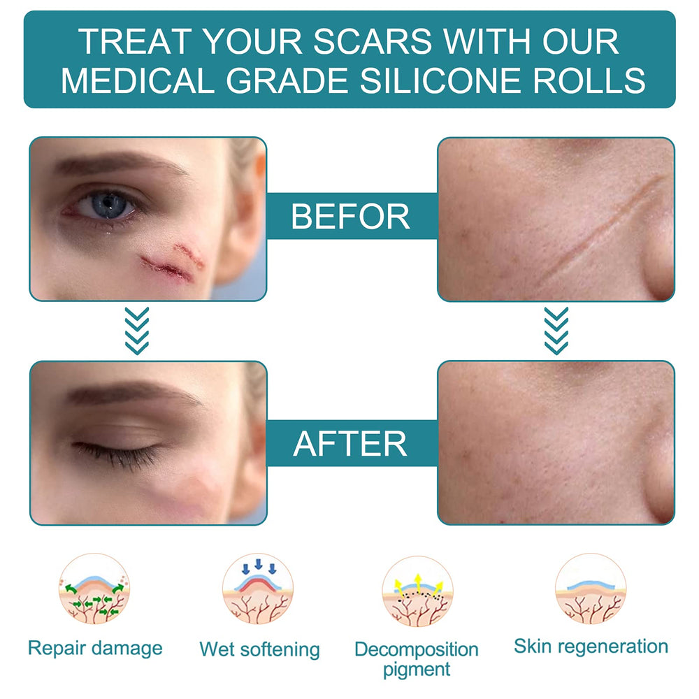 Scar tape applied over old and new scars for even coverage.
