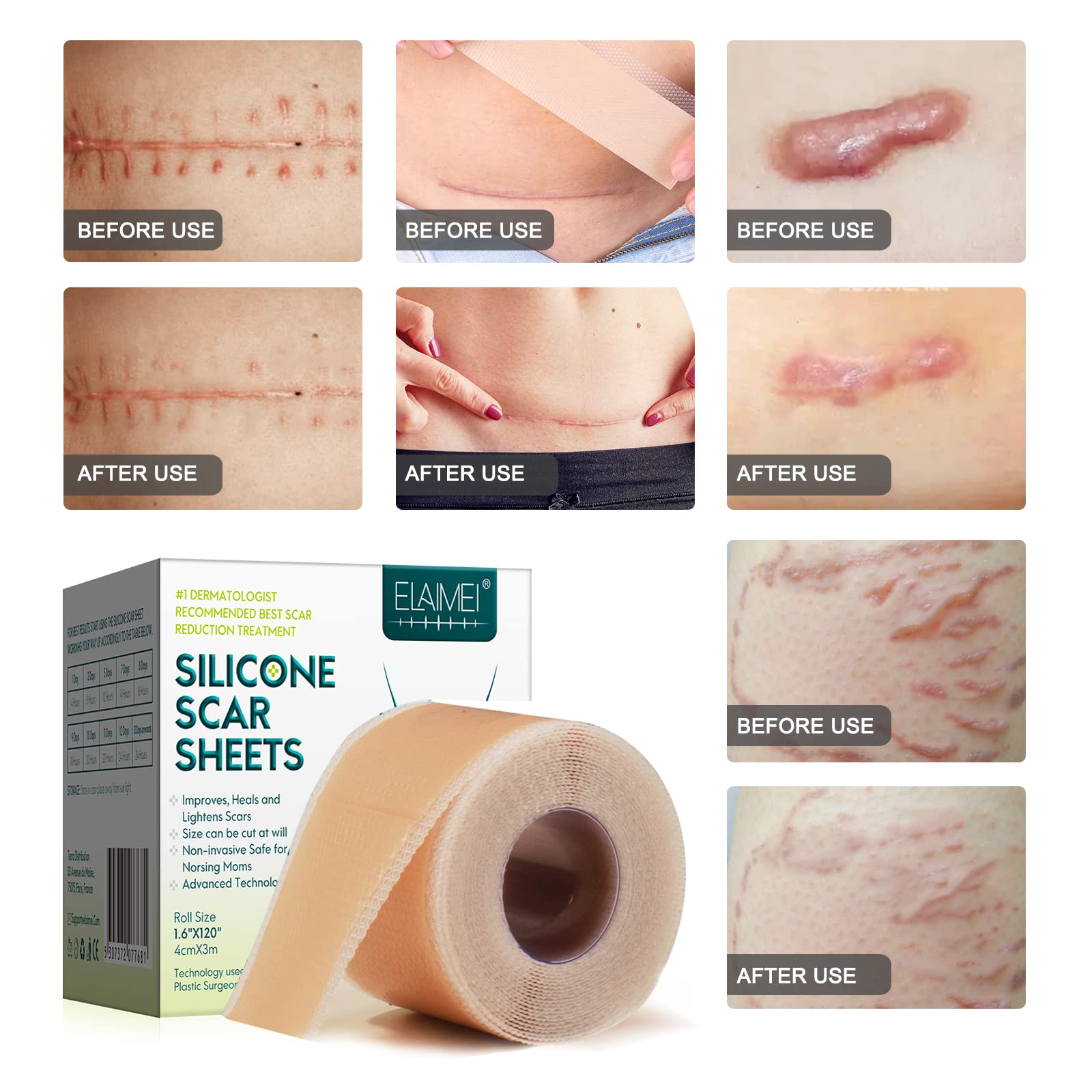 ZODENIS sheet reducing itching and redness when worn over a scar