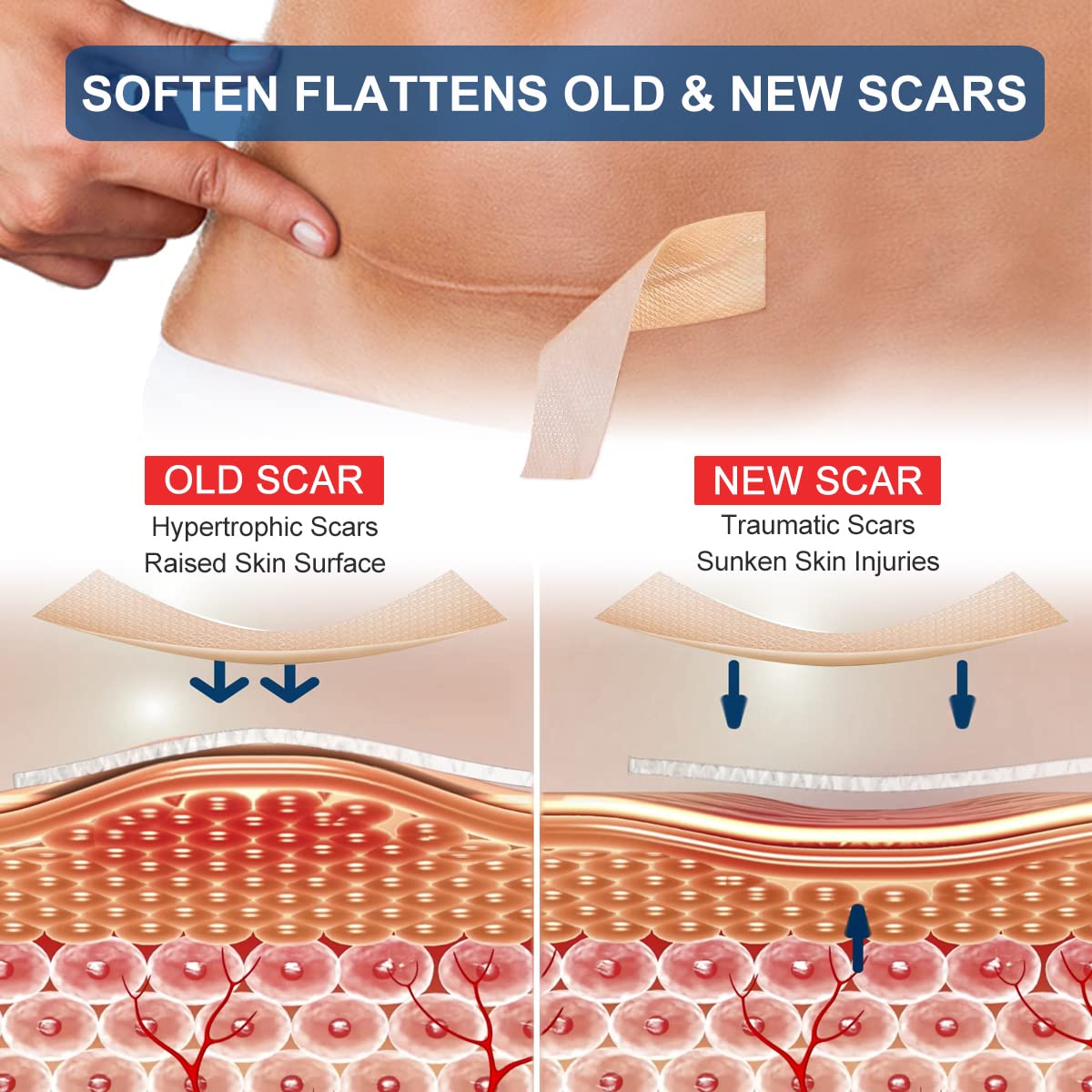 ZODENIS silicone scar sheets in soft skin contact for sensitive areas