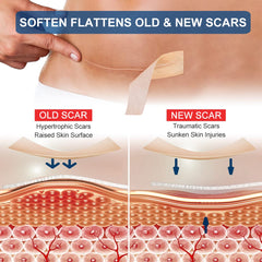 ZODENIS silicone scar sheets in soft skin contact for sensitive areas