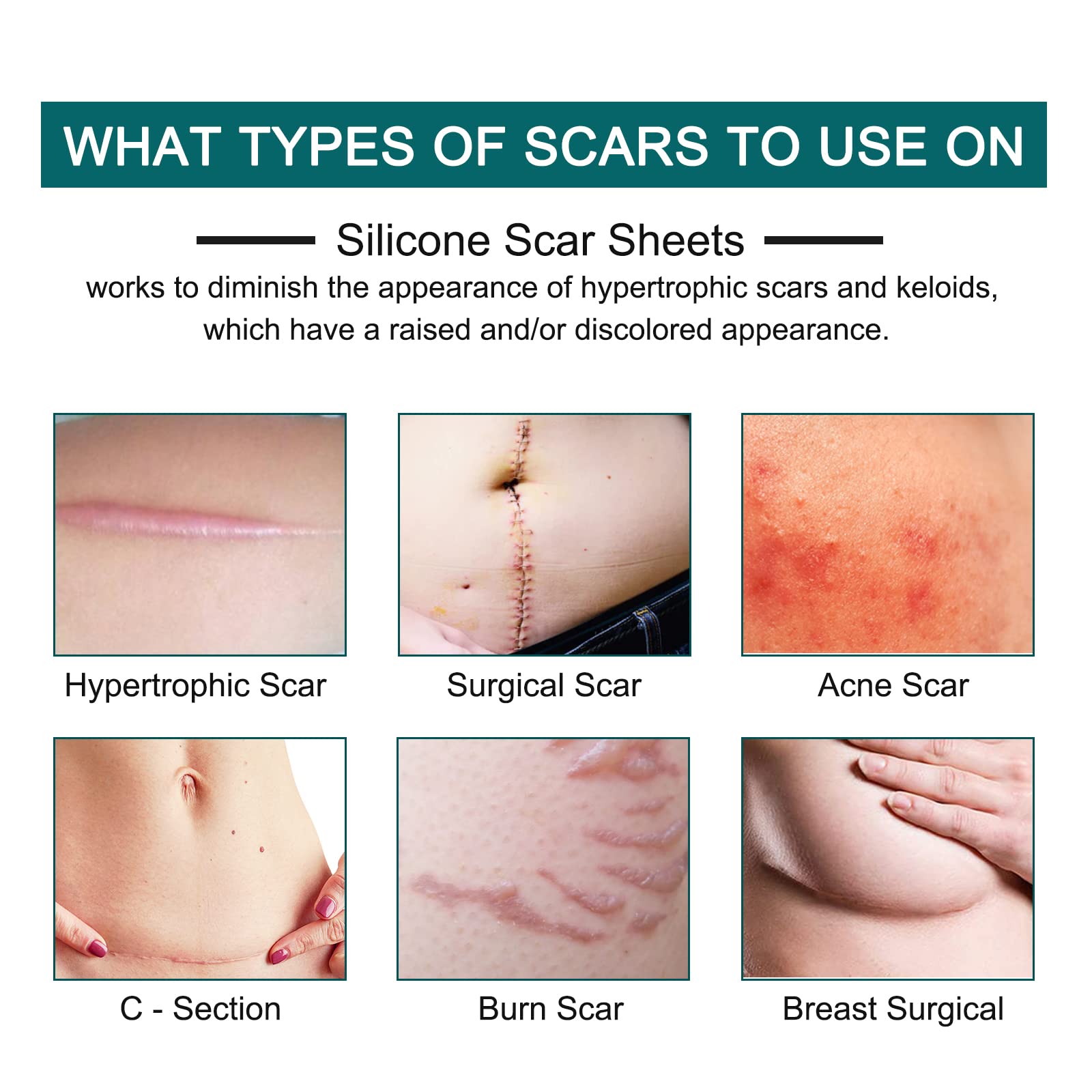 ZODENIS silicone scar tape applied over a scar showing secure adhesion