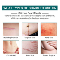 ZODENIS silicone scar tape applied over a scar showing secure adhesion